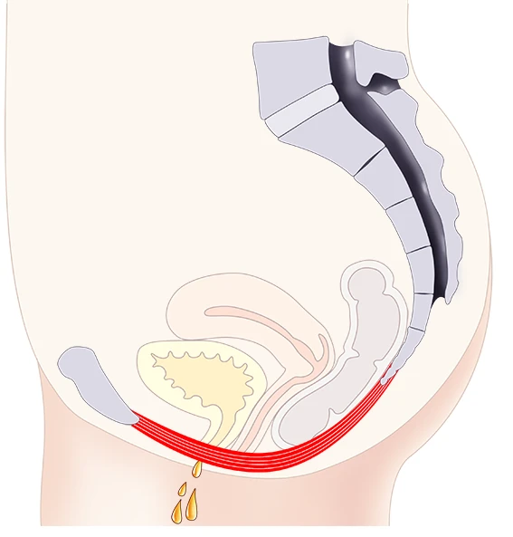 Anatomische Darstellung: Geschwächter Beckenboden mit abgesenkten Organen und Urinverlust