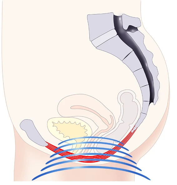 Anatomische Darstellung: EMSELLA® HIFEM-Energie stimuliert die Beckenbodenmuskulatur