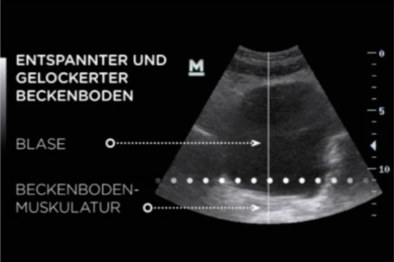 Ultraschallbild: Entspannter und gelockerter Beckenboden vor der EMSELLA®-Behandlung