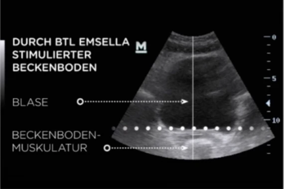 Ultraschallbild: Durch BTL EMSELLA® stimulierter und gestärkter Beckenboden