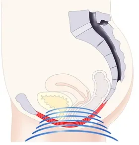 Anatomische Darstellung der HIFEM-Stimulation des Beckenbodens während der EMSELLA®-Behandlung in Wolfratshausen