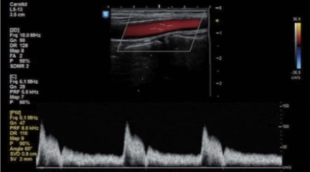 Mit den Dopplerduplex Ultraschall kann die Durchblutung von Organen, z.B. den Nieren, untersucht werden.